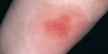 Если вас кусают: cимптомы и лечение укусов насекомых﻿